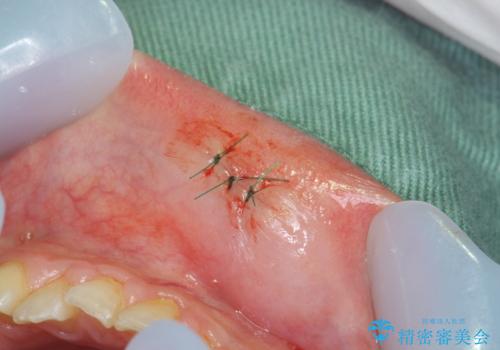 粘液嚢胞の切除の治療中