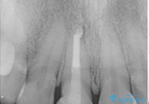 根管治療と並行して矯正を マウスピース治療の治療中