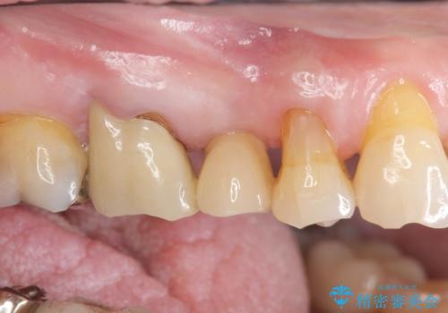 失った奥歯のインプラント治療の症例 治療後