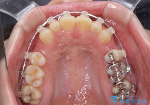 気になる出っ歯を治したい　ワイヤー装置の抜歯矯正でスッキリした横顔にの治療中