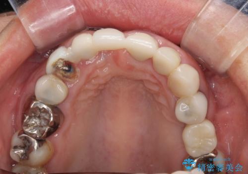 割れてしまった歯と深いむし歯 部分矯正と外科処置で安定したブリッジ治療の治療中