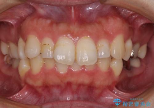 気になる出っ歯を治したい ワイヤー装置の抜歯矯正でスッキリした横顔にの症例 治療前