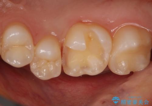 奥歯の保険の詰め物を自費のものに変えたいの治療中