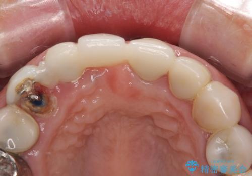 割れてしまった歯と深いむし歯　部分矯正と外科処置で安定したブリッジ治療の治療中