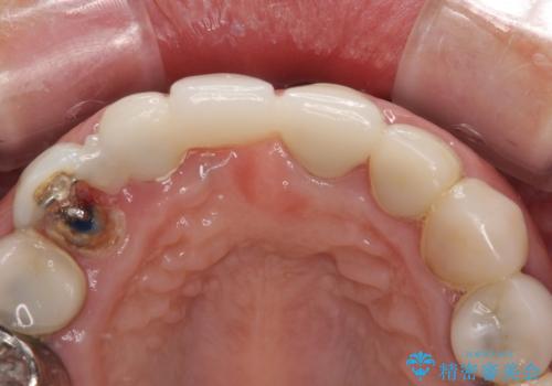 割れてしまった歯と深いむし歯 部分矯正と外科処置で安定したブリッジ治療の治療中