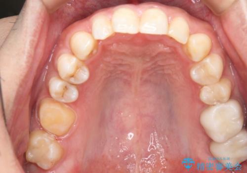 銀歯を白くしたい フルジルコニアクラウンとセラミックインレーの治療中