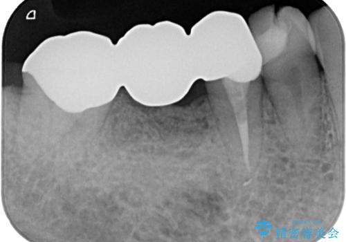 詰め物が割れた フルジルコニアクラウンの治療前