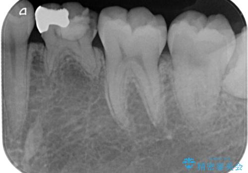 乳歯に虫歯ができた オールセラミッククラウンの治療前