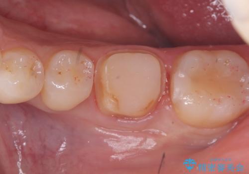 【セラミッククラウン】歯がポロポロ欠けたの治療中