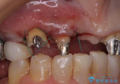 割れてしまった歯と深いむし歯 部分矯正と外科処置で安定したブリッジ治療の治療中