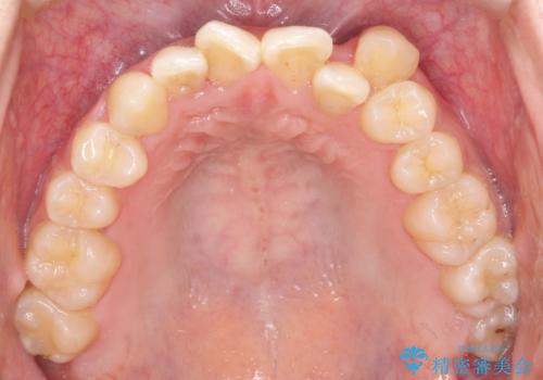 左上の八重歯を抜歯矯正|インビザライン×ワイヤー矯正の併用で理想の歯並びへの治療前