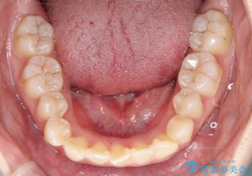 ハーフリンガル矯正|下顎前歯3本の特異症例を抜歯矯正で改善の治療前