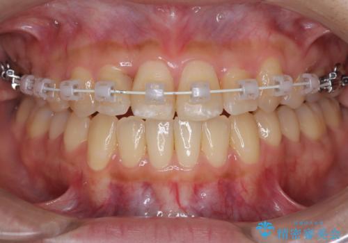 左上の八重歯を抜歯矯正|インビザライン×ワイヤー矯正の併用で理想の歯並びへの治療中