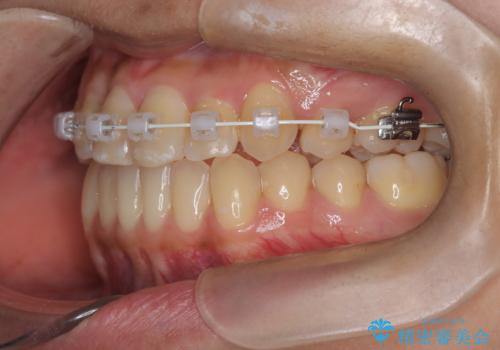 左上の八重歯を抜歯矯正|インビザライン×ワイヤー矯正の併用で理想の歯並びへの治療中