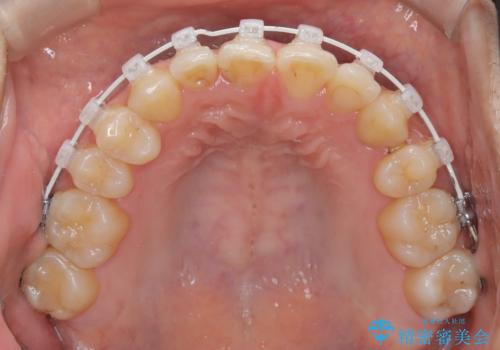 左上の八重歯を抜歯矯正|インビザライン×ワイヤー矯正の併用で理想の歯並びへの治療中