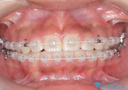 前歯の突出を抜歯なしで改善|リンガルアーチ×TADを活用した矯正治療の治療中