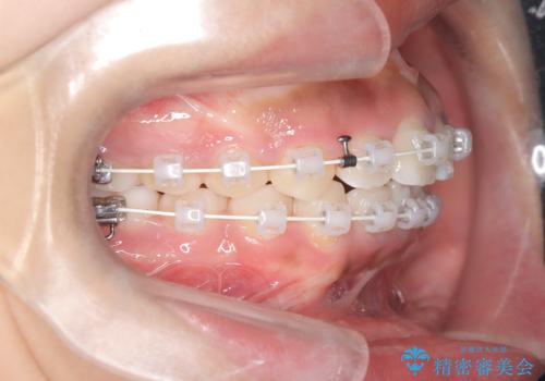 前歯の突出を抜歯なしで改善|リンガルアーチ×TADを活用した矯正治療の治療中