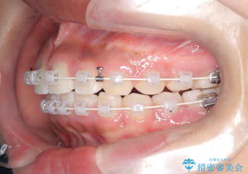 前歯の突出を抜歯なしで改善|リンガルアーチ×TADを活用した矯正治療の治療中