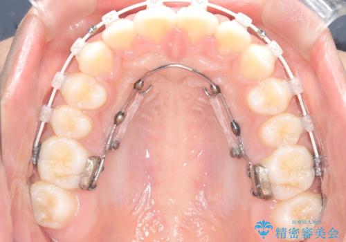 前歯の突出を抜歯なしで改善|リンガルアーチ×TADを活用した矯正治療の治療中