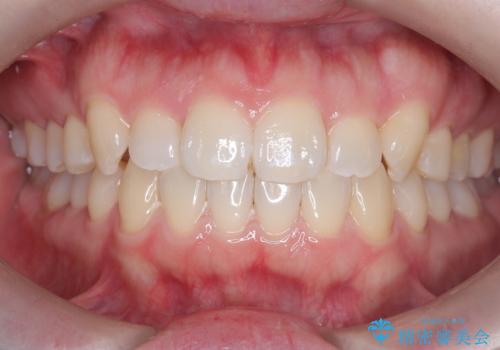 インビザライン×ワイヤー矯正の併用で理想の歯並びへ|MTMで小臼歯のねじれも改善の治療後