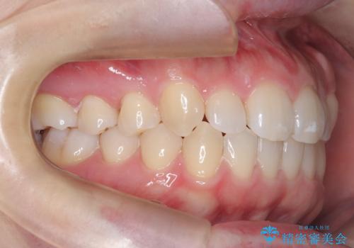 インビザライン×ワイヤー矯正の併用で理想の歯並びへ|MTMで小臼歯のねじれも改善の治療後