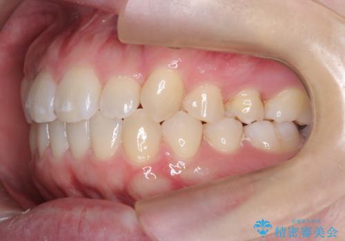 インビザライン×ワイヤー矯正の併用で理想の歯並びへ|MTMで小臼歯のねじれも改善の治療後