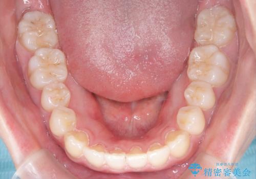 インビザライン×ワイヤー矯正の併用で理想の歯並びへ|MTMで小臼歯のねじれも改善の治療後