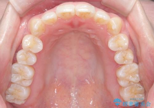 インビザライン×ワイヤー矯正の併用で理想の歯並びへ|MTMで小臼歯のねじれも改善の治療後
