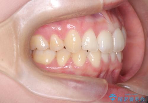 抜歯矯正×インビザライン|上下のバランスを整え、美しい歯並びへの治療後