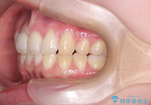 抜歯矯正×インビザライン|上下のバランスを整え、美しい歯並びへの治療後