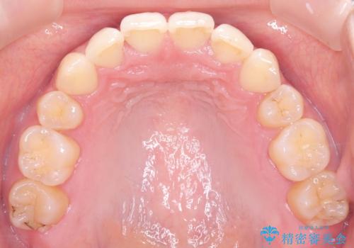 抜歯矯正×インビザライン|上下のバランスを整え、美しい歯並びへの治療後