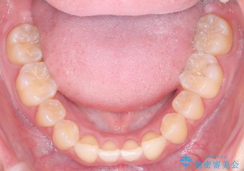 抜歯矯正×インビザライン|上下のバランスを整え、美しい歯並びへの治療後