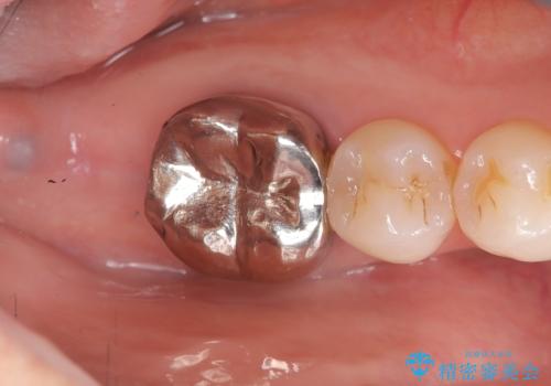 歯のインプラント治療|1回の手術で負担を軽減し、自然な噛み心地を再現の治療前