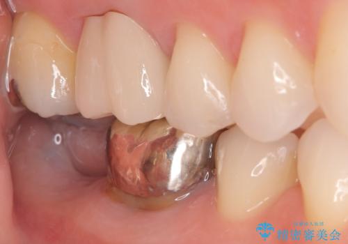 歯のインプラント治療|1回の手術で負担を軽減し、自然な噛み心地を再現の治療前