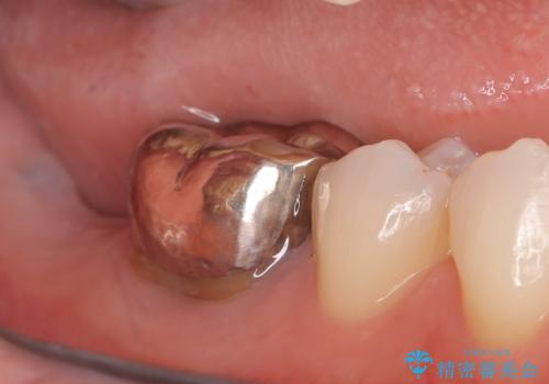 歯のインプラント治療|1回の手術で負担を軽減し、自然な噛み心地を再現の治療前