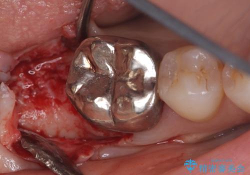 歯のインプラント治療|1回の手術で負担を軽減し、自然な噛み心地を再現の治療中