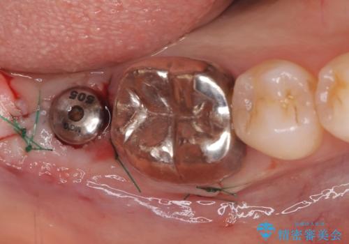 歯のインプラント治療|1回の手術で負担を軽減し、自然な噛み心地を再現の治療中