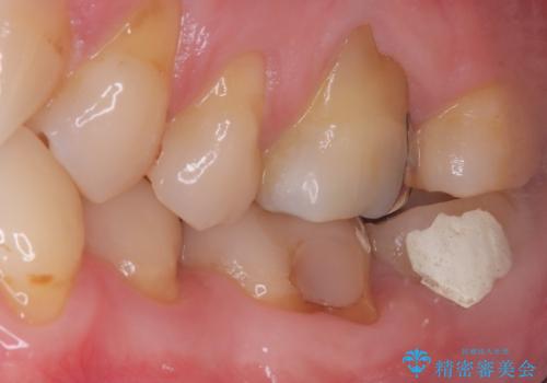 他院の根管治療後の違和感を解消!精密な根管治療で健康な歯を守るの治療前