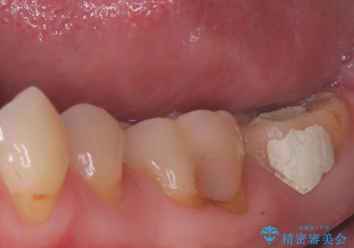 他院の根管治療後の違和感を解消!精密な根管治療で健康な歯を守るの治療前