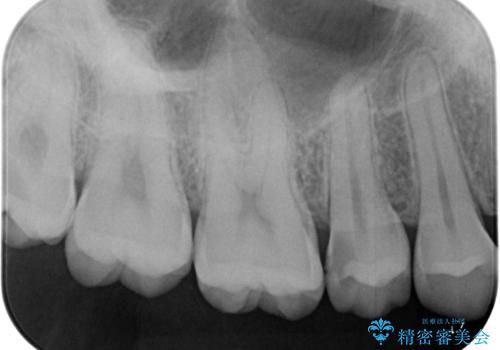 歯間部の自分では気づきにくい虫歯　セラミックインレー修復の治療前