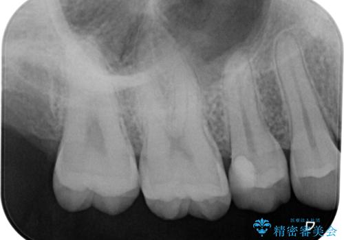 歯間部の自分では気づきにくい虫歯　セラミックインレー修復の治療後