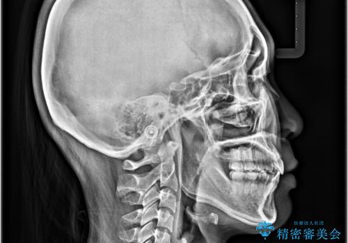 口元の突出感を改善したい。審美装置による抜歯矯正の治療後