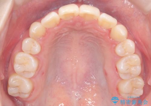 ハーフリンガル矯正|下顎前歯3本の特異症例を抜歯矯正で改善の治療後