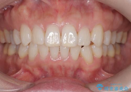 インビザラインで非抜歯矯正|ゴムかけで下顎犬歯の低位を改善し、噛み合わせも最適化の治療後