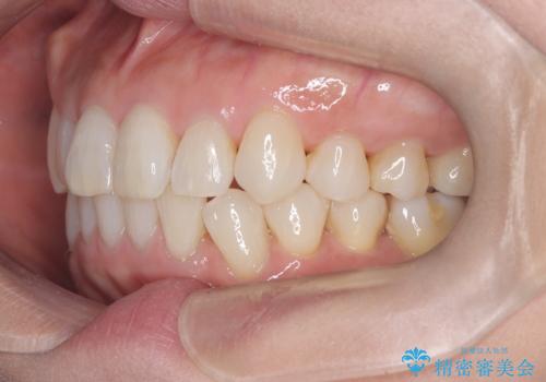 インビザラインで非抜歯矯正|ゴムかけで下顎犬歯の低位を改善し、噛み合わせも最適化の治療後