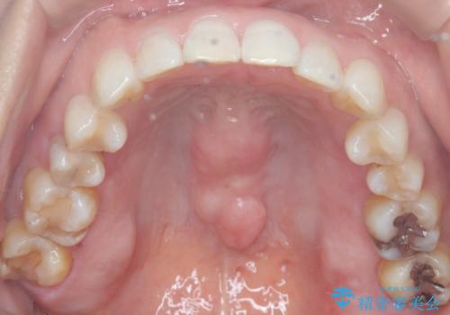 インビザラインで非抜歯矯正|ゴムかけで下顎犬歯の低位を改善し、噛み合わせも最適化の治療後