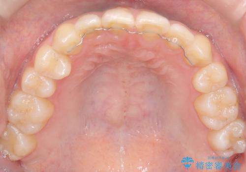 左上の八重歯を抜歯矯正|インビザライン×ワイヤー矯正の併用で理想の歯並びへの治療後