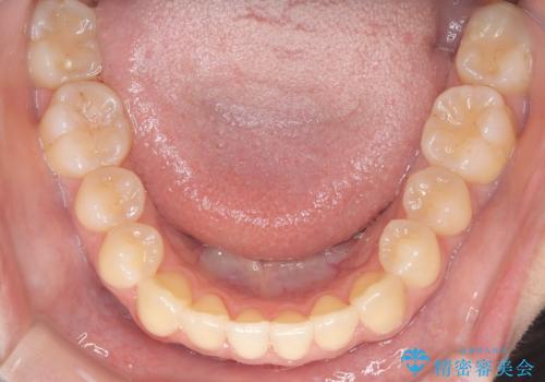 左上の八重歯を抜歯矯正|インビザライン×ワイヤー矯正の併用で理想の歯並びへの治療後