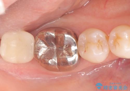 歯のインプラント治療|1回の手術で負担を軽減し、自然な噛み心地を再現の治療後