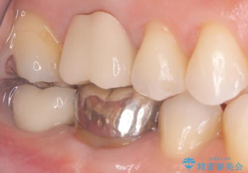 歯のインプラント治療|1回の手術で負担を軽減し、自然な噛み心地を再現の治療後